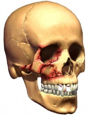 Maxillofacial fracture's management